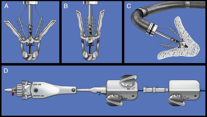 2014 Hot Topic: Rollout of the MitraClip - American College of Cardiology